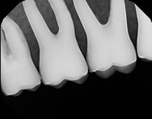 Load image into Gallery viewer, Dexis Platinum Intraoral Digital X-Ray Dental Sensor Size 2
