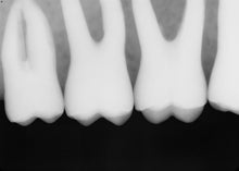 Load image into Gallery viewer, Sirona Schick 33 Digital Dental X-Ray Sensor Size 2
