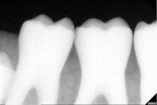 Load image into Gallery viewer, Acteon SoPix 2 Digital Intraoral Dental X-Ray Sensor Size 1
