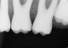 Load image into Gallery viewer, Sirona Schick 33 Dental Intraoral X-Ray Sensor Size 2
